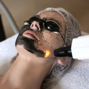 Carbon Peel (Hollywood Facial)