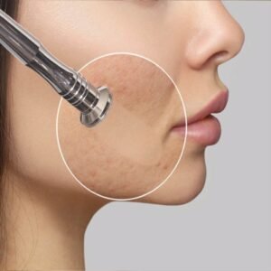 Microdermabrasion & Facial