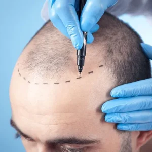 For Scalp Coverage